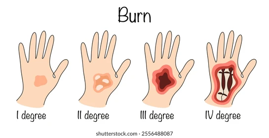 <ul><li><p>Extends to deeper tissue (bone, muscle, tendon)</p></li><li><p>Appears dry/leathery</p></li><li><p>Amputation is possible and sometimes required</p></li></ul><p></p>