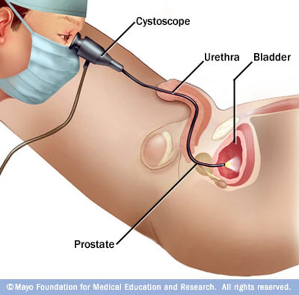 <p>visual examination of the urinary bladder using a cystoscope</p>