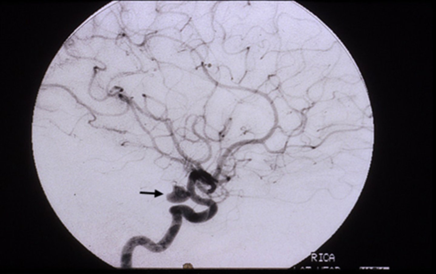 <p>fixed, dilated pupil (esp if painful like HA) = anuerysm at the junction of the ICA and posterior communicating artery</p><p>pupil-sparing (may or may not be painful like eye pain) = diabetes or ischemic vascular etiology</p><p>NOTE: can change from pupil-sparing to pupil-involved if it is an aneurysm</p>