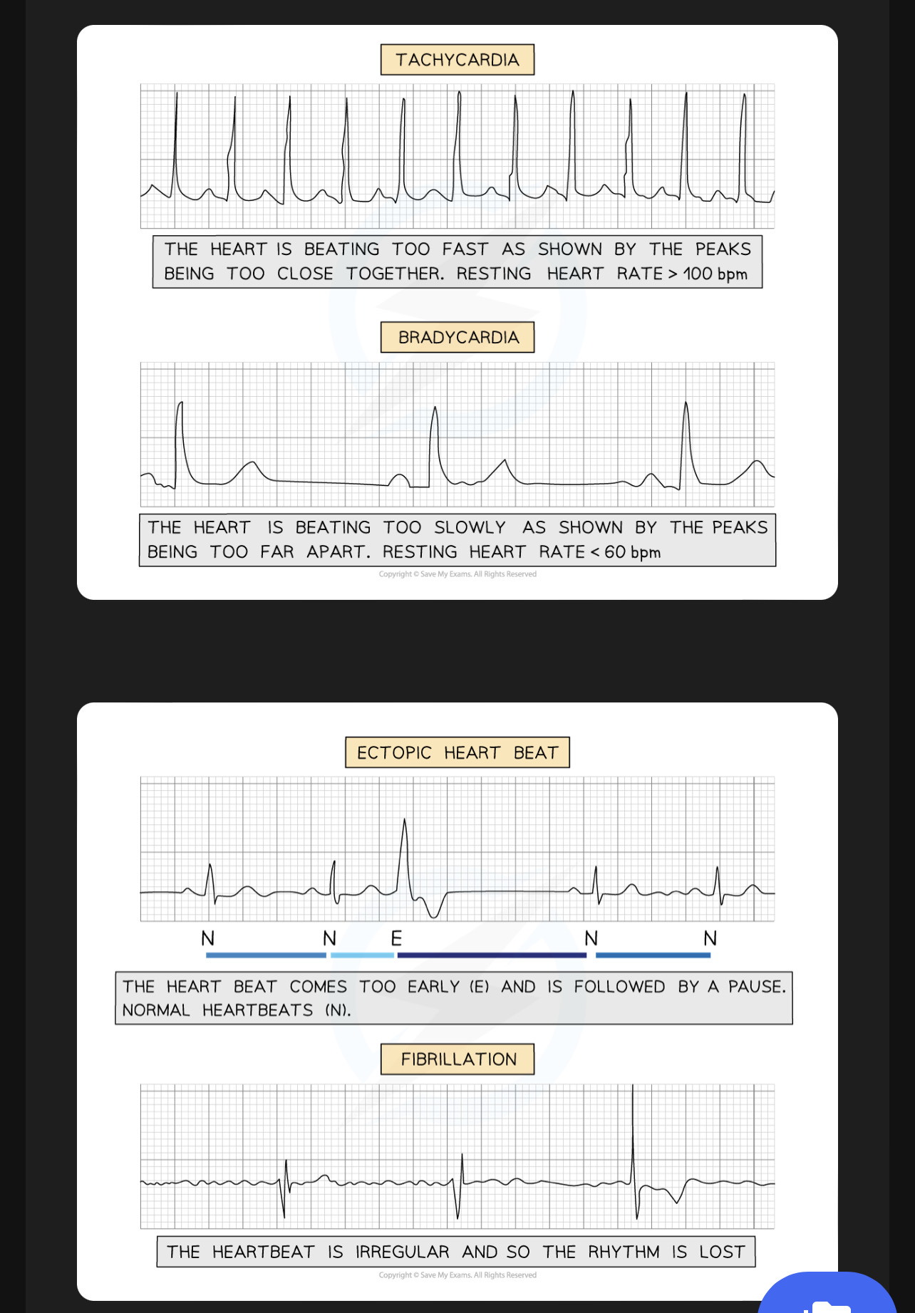 <p>Tachycardia, Bradycardia, ectopic heartbeat, Fibrillation (atrial or ventricular fibrillation)</p>