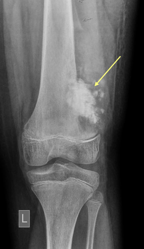 <p>What is osteosarcoma?</p>