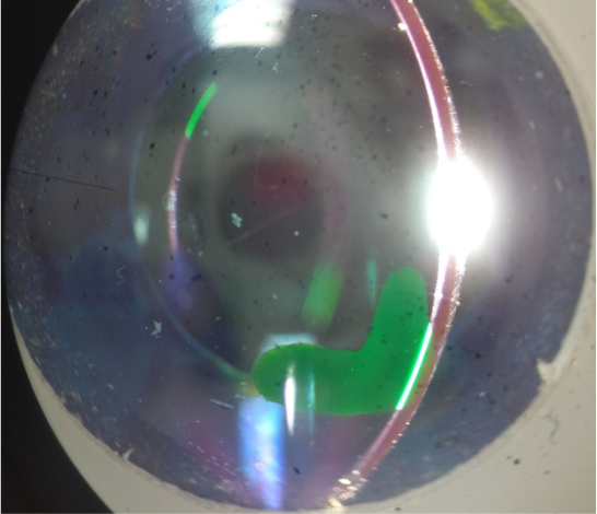 <p>which layer of the cornea is the green lesion located in?</p>