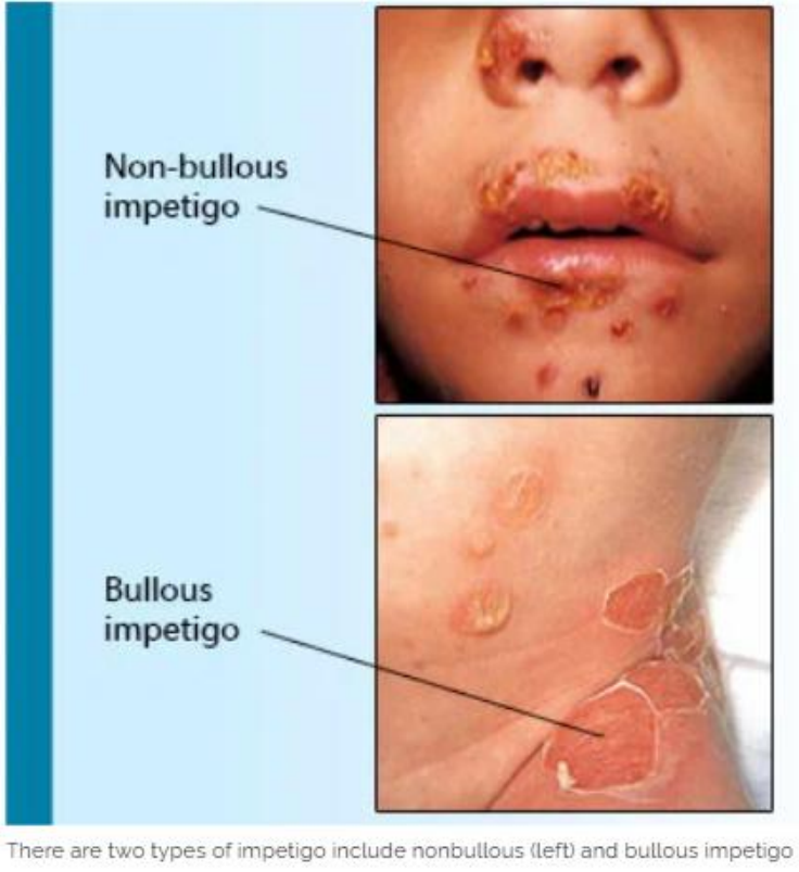 <ul><li><p>Non-bullous</p></li><li><p>Thin-walled, reddish vesicles that rupture easily</p></li><li><p>Forming golden/brown crusts</p></li><li><p>Typically around the mouth, nose, or limbs</p></li></ul><p>—</p><p><em>For adults or anyone over 1 year</em></p><p></p>