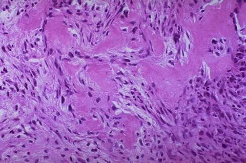 <ol><li><p>Cellular composition of osteosarcoma</p></li><li><p>Histologic feature confirming osteosarcoma</p></li></ol><p></p>