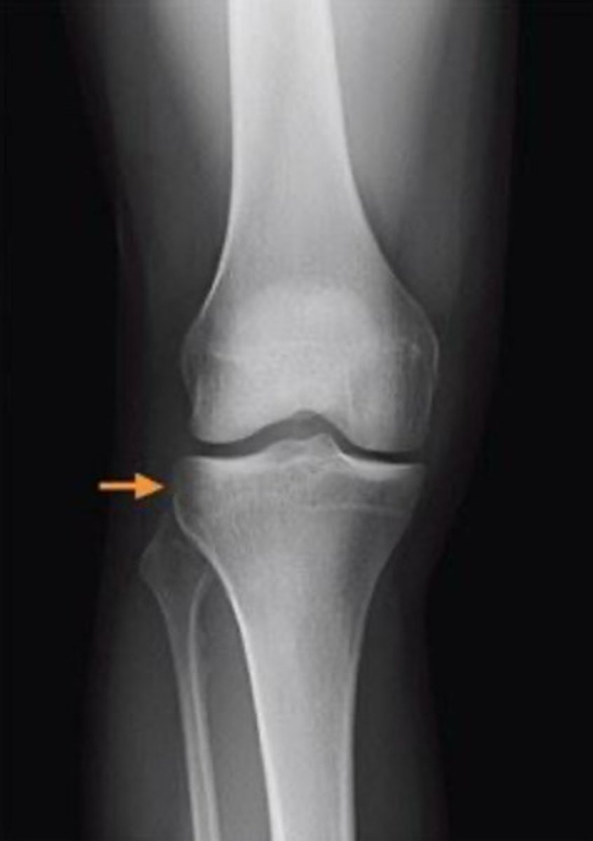 <p>segond fracture</p><p>3 multiple choice options</p>