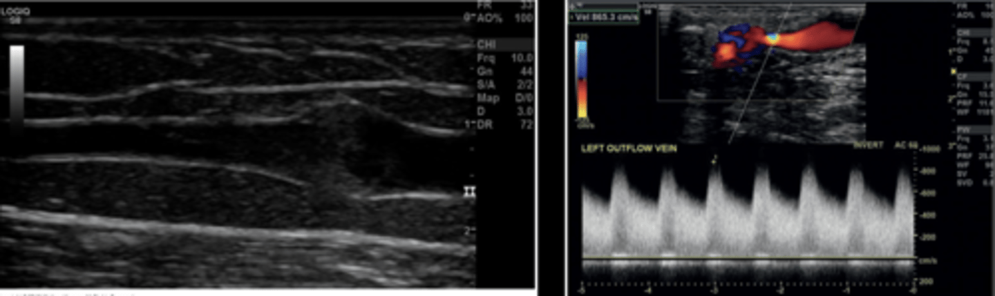 <p>Most common in venous anastomosis &amp; outflow vein</p><p>Echogenic intraluminal lesion</p><p>Flow reduction</p>