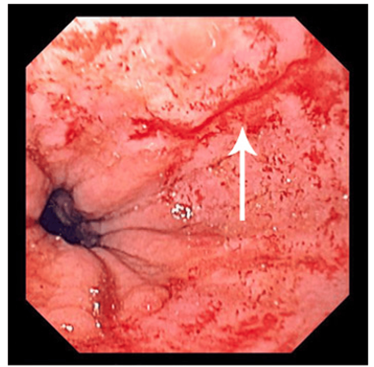 <p>Identify this complication of N/V:</p><p>Mucosal Tear at EG Junction</p>