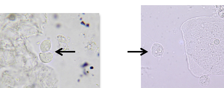 <ul><li><p class="">Most common urinary parasite</p></li><li><p class="">Pear-shaped flagellate with undulating membrane</p></li><li><p class="">Motile in fresh specimens</p></li><li><p class="">Non-motile forms mimic WBCs or epithelial cells</p></li><li><p class="">Confirm via patient history or video microscopy</p><p class=""></p></li></ul><p></p>