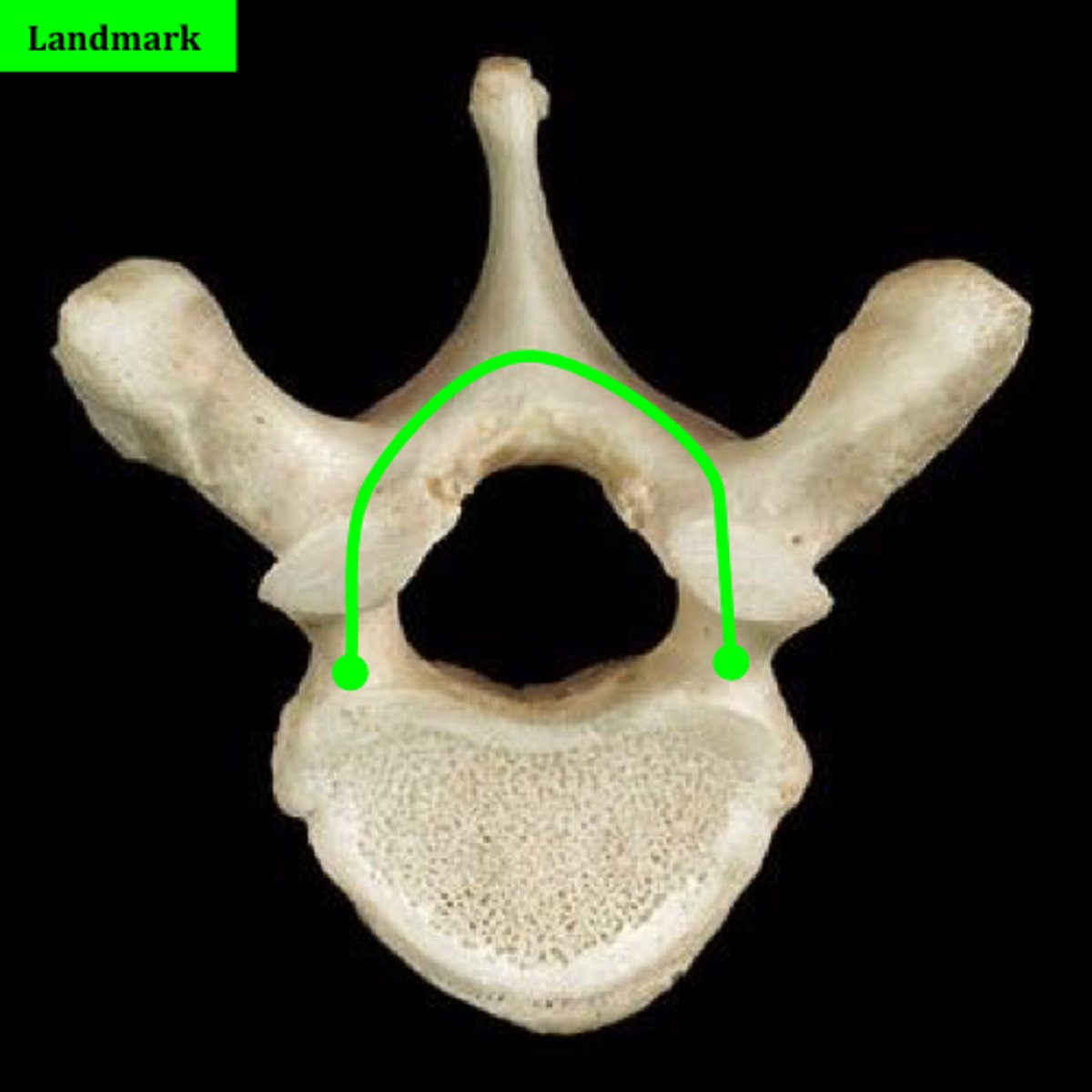 <p>Entire top part of the vertebra until the vertebral body</p><p>Name this region</p>