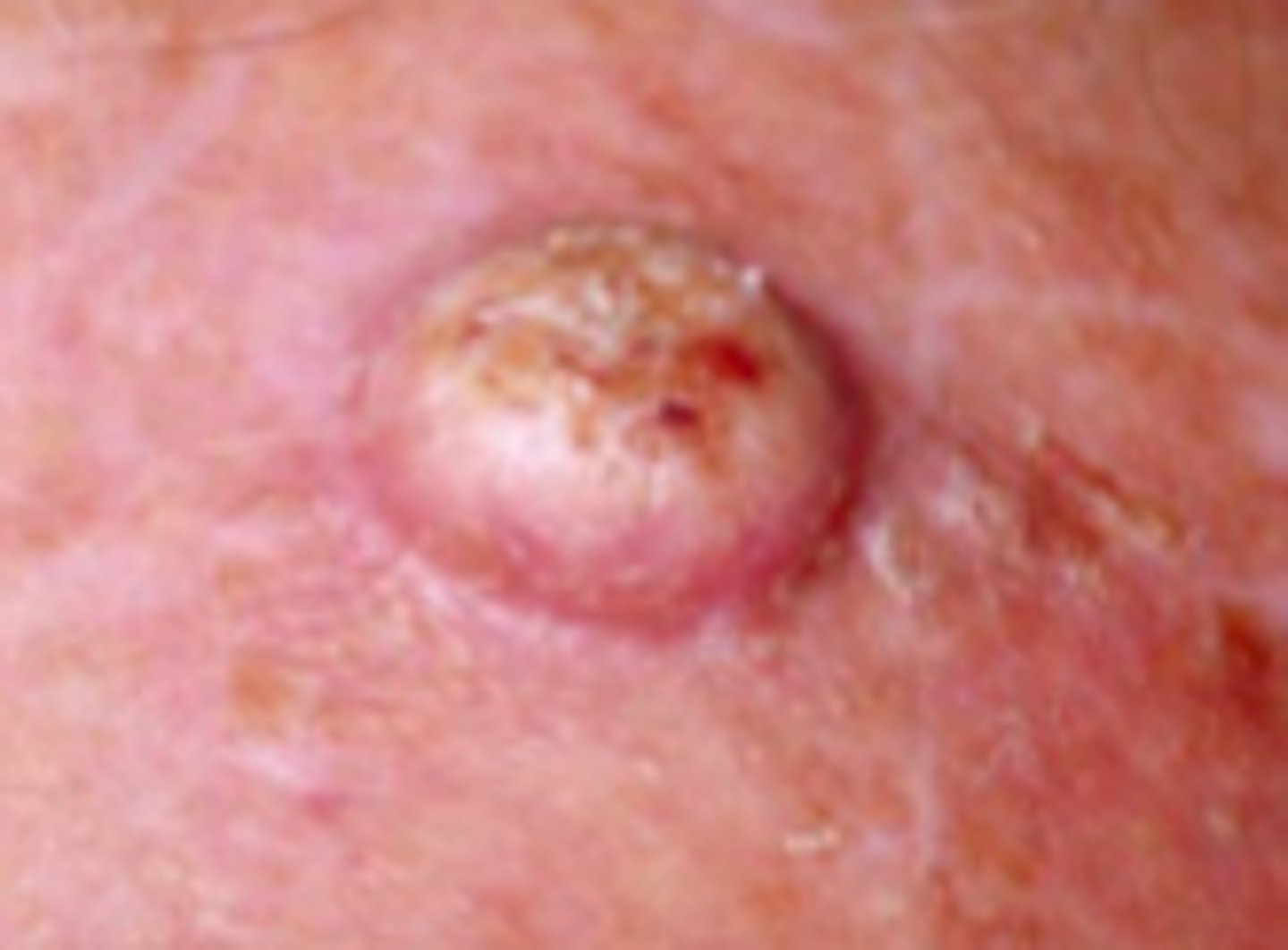 <p>Neoplasms:</p><p>type of SCC</p>