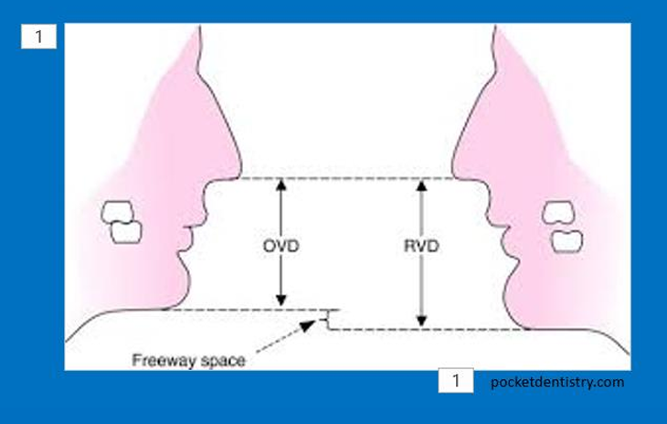 <p>Use the freeway space FWS as a guide instead</p><ul><li><p>Mandible relaxed with lips together , teeth are usually apart at rest - vertical measurements between maxilla and mandible - rest vertical dimension- OVD is when teeth are in contact</p></li><li><p>the gap between is the free way space</p></li><li><p>If no FWS then in rest there is no gap</p></li></ul><p>with any patient at rest regardless of what’s in mouth you can measure the RVD instead - OVD can be calculated from the free way space avg</p><p>use FWS to determine the OVD</p>