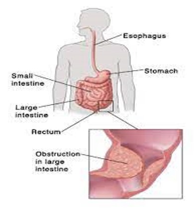 <p>Blockage of bowel lumen</p>