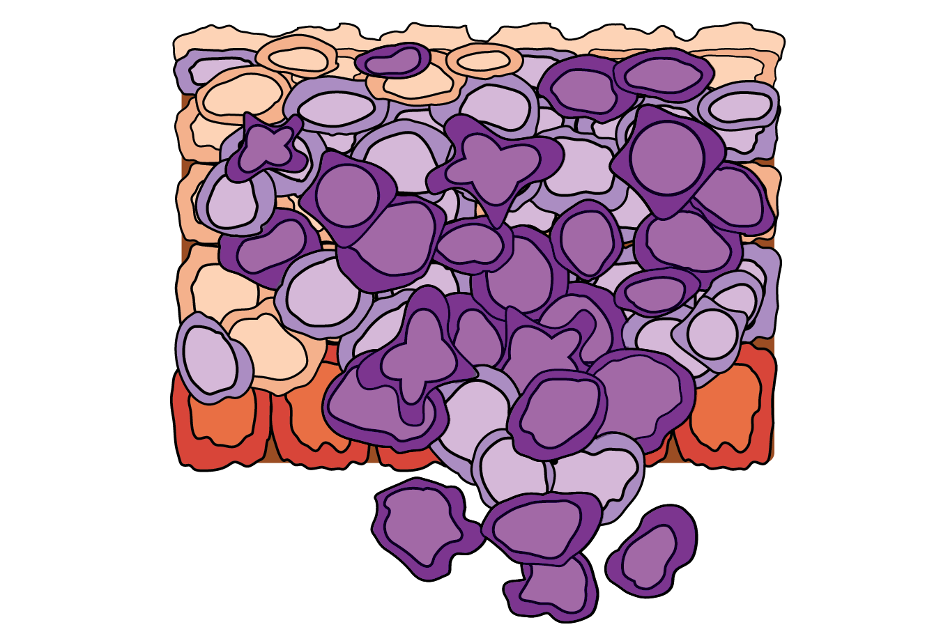 <p><span>The tissue shows uncontrolled growth of cells and abnormal tissue arrangement and cell structure, which do not remain within the original location.</span></p>