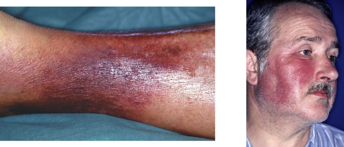 Erysipelas: Streptococcal skin infection
