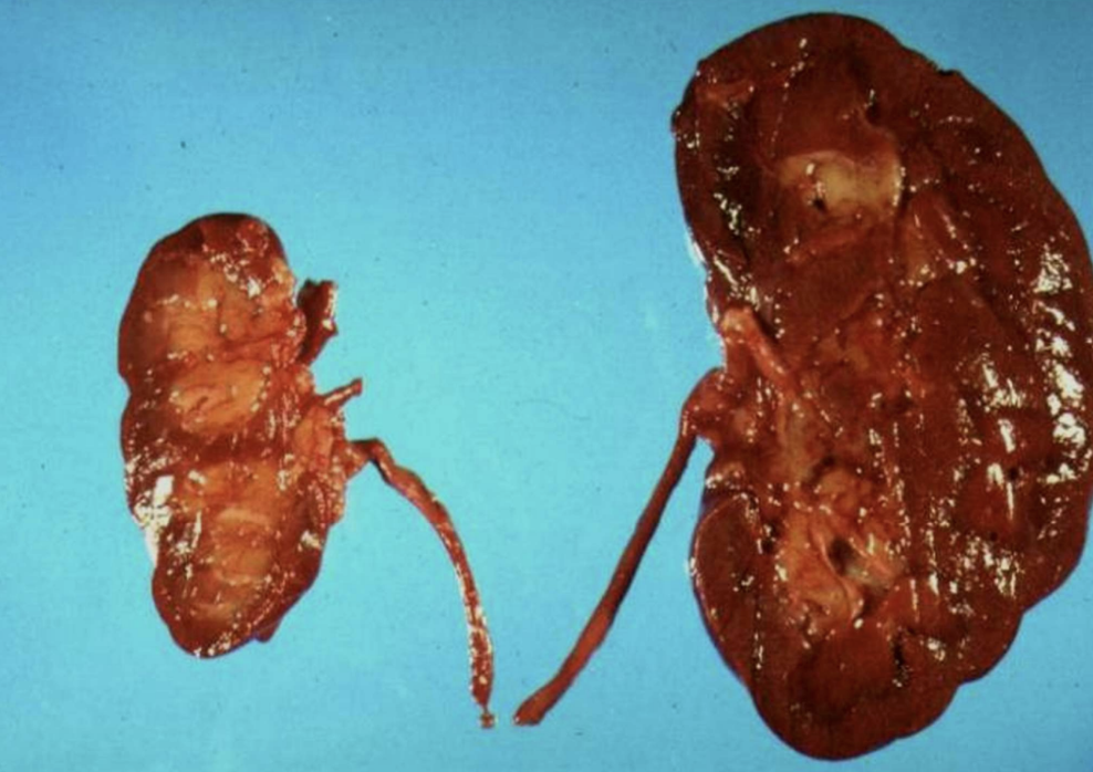 <p>Ischemic Organ Atrophy</p>