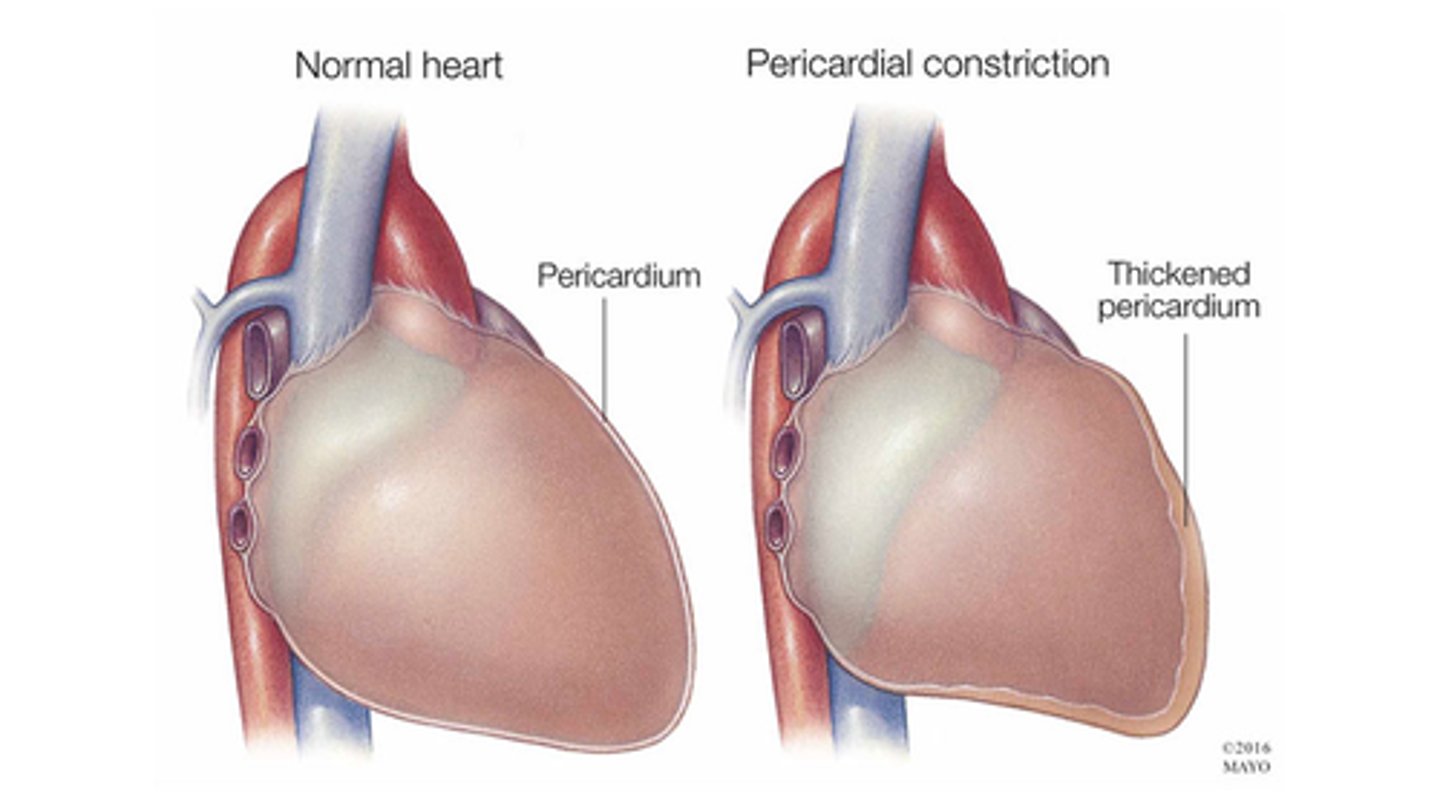 <p>-long-term or chronic inflammation of pericardium</p><p>-loss of elasticity from chronic inflammation</p><p>-can result in a thickened pericardium</p><p>-becomes thick and fibrous and sticky and gets stuck on the heart</p><p>-decreased cardiac output</p>
