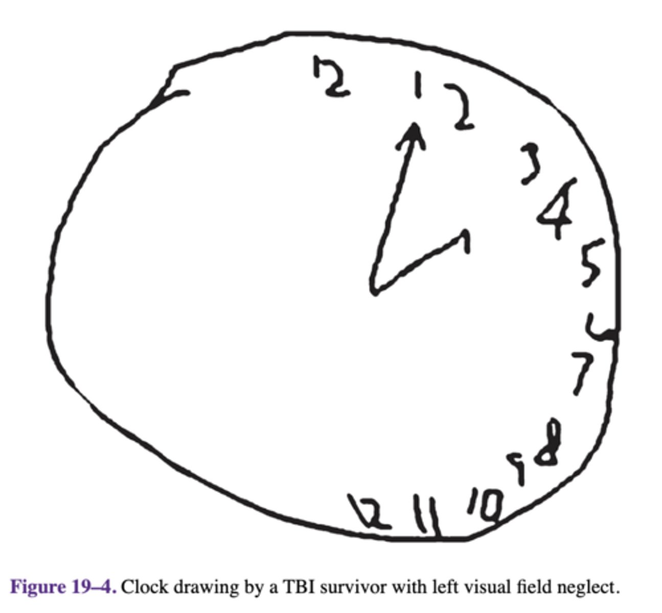 <p>visual field neglect</p>