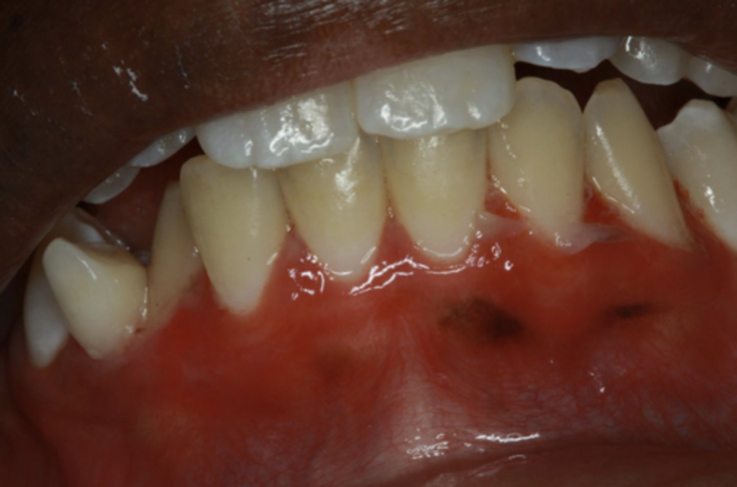 <p>Patient presents with these lesions along with ocular lesions and an autoimmune disorder with autoantibodies to hemidesmosomes. What condition do you suspect?</p>