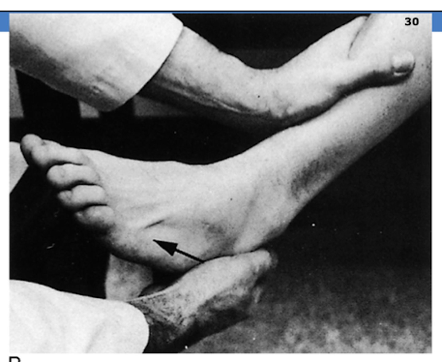 <p>anterior drawer test</p><p>(+) → anterior dislocation; "clunk"</p>