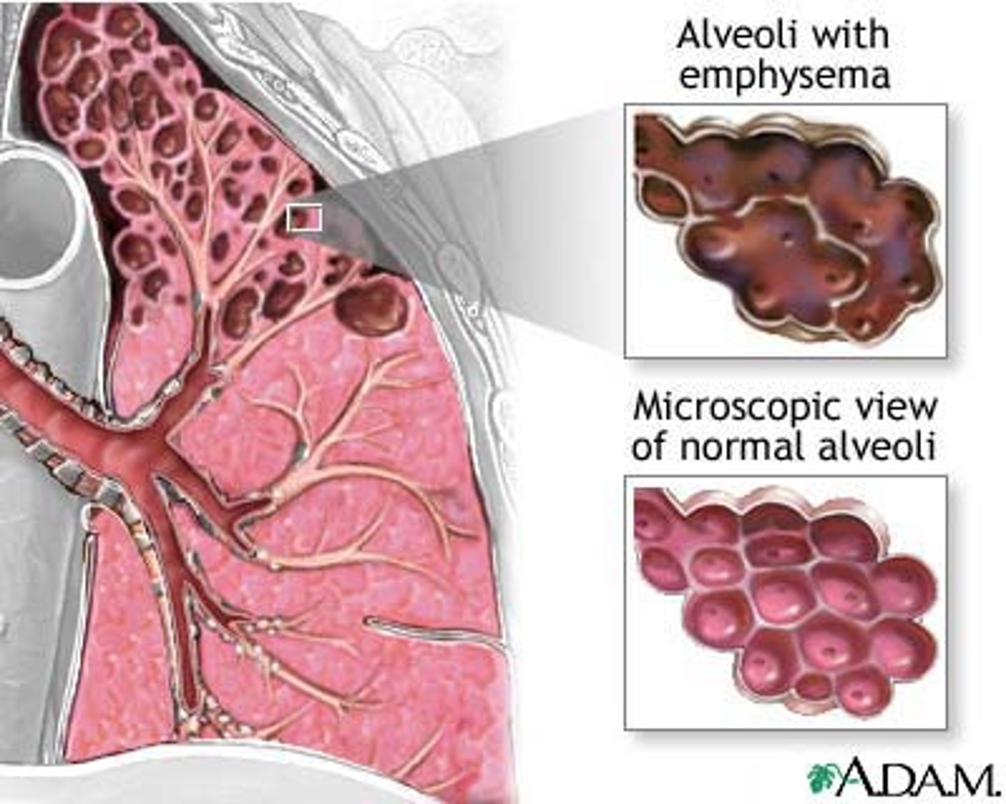 <p>a condition in which the air sacs of the lungs are damaged and enlarged, causing breathlessness.</p>