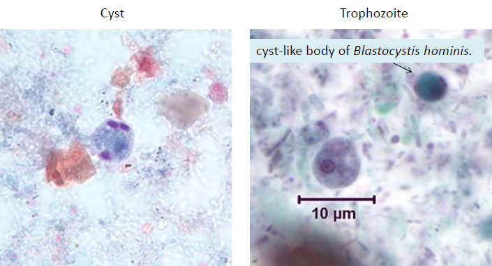 <p>Cyst</p><ul><li><p>smaller, but like E. histo</p></li><li><p>Diffuse glycogen</p></li><li><p>5-10 micron</p></li></ul><p>Trophozoite </p><ul><li><p>small, compact karyosome</p></li><li><p>5-15 micron</p></li></ul><p></p>
