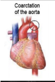 <p>constriction of arch of aorta (congential defect)</p><p>may cause rib notching due to collateral circulation involving internal thoracic and intercostal arteries</p>