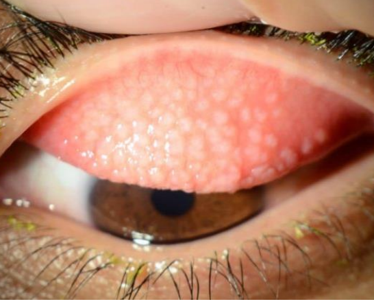 <ol><li><p>• Non-infectious inflammatory condition of the<strong><u> </u><mark data-color="yellow" style="background-color: yellow; color: inherit"><u>superior </u></mark><u>tarsal conjunctiva with the presence of “giant papillae” (papillae greater than 1 mm in diameter)</u></strong></p><ol><li><p><u>Thought to be mechanical trauma and inflammatory in the presence of CL antigens</u></p><ol><li><p>if contact lens doesnt fit you get friction w superior palpebral conj</p></li></ol></li></ol></li></ol><p></p>