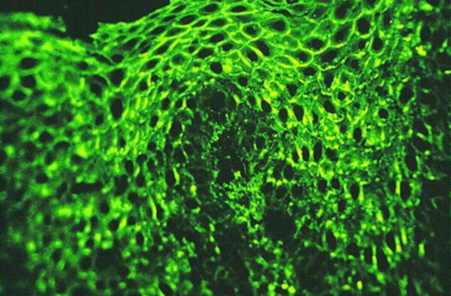 <p>pemphigus vulgaris</p>