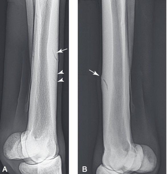 <ul><li><p><span>Some develop one or more oblique radiolucent lines in the dorsal cortex accompanied with focal pain and swelling</span></p><ul><li><p><span>Occur most commonly in 3 year old Thoroughbreds after they experience bucked shin problems in their 2 year old season</span></p></li><li><p><span>Most common configuration is a line coursing proximally at a 30-40 degree angle from the surface of the middistal dorsolateral cortex of the left MCIII</span></p></li></ul></li><li><p><span>Typically the fissure extends approximately 60-70% through the dorsal cortex and disappears, but in some cases the crack curves proximad and courses back to the dorsal cortex, forming a true saucer fracture</span></p><ul><li><p><span>Fractures may occur in the opposite configuration (proximodorsal to distopalmar) as well as anywhere along the length of MCIII</span></p></li></ul></li></ul>