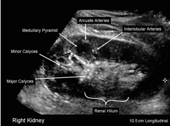 <p>In your assessment of the intrarenal arteries at level of arcuate or interlobular arteries, is it necessary to angle correct? Select best answer. </p>