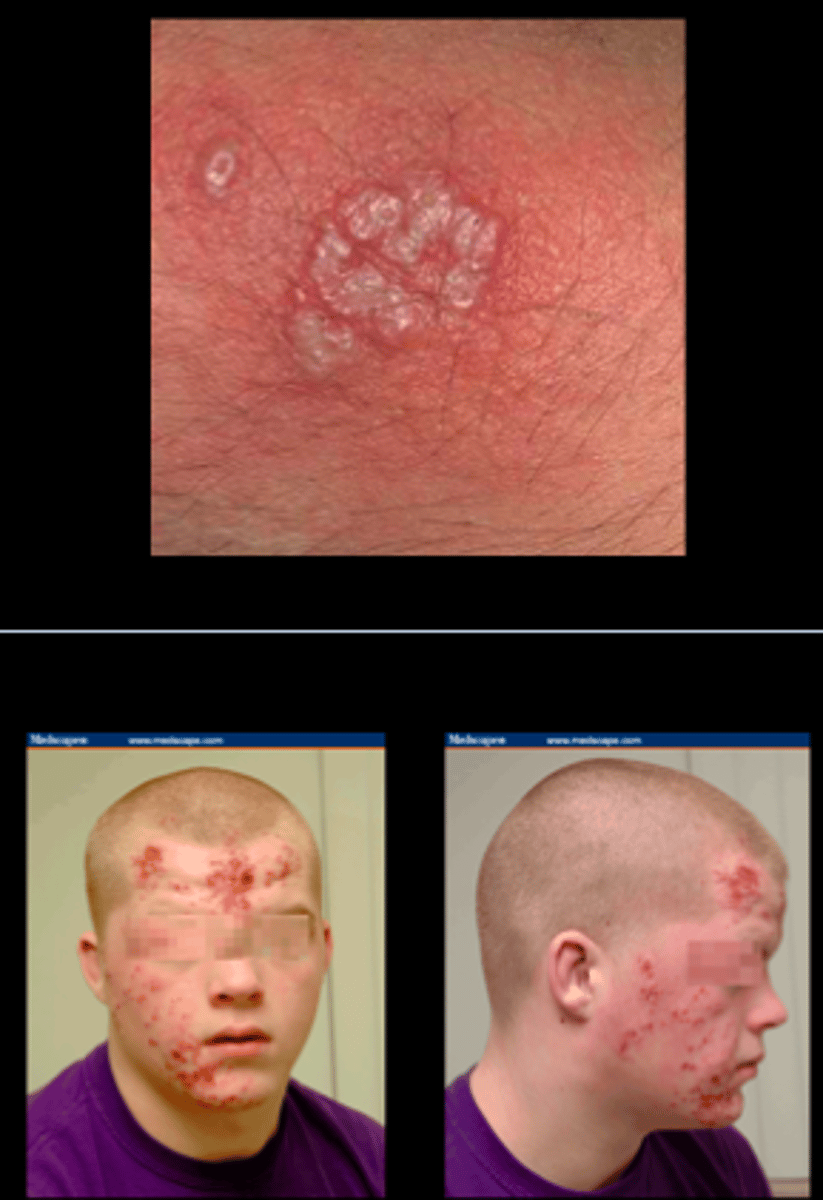 <p>HSV1 common in wrestlers<br>Lesions on head and neck</p>