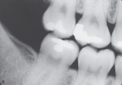 <p>The crowns of the maxillary and mandibular molars (2nd &amp; 3rd molars) and the distal half of the 1st molar.</p>