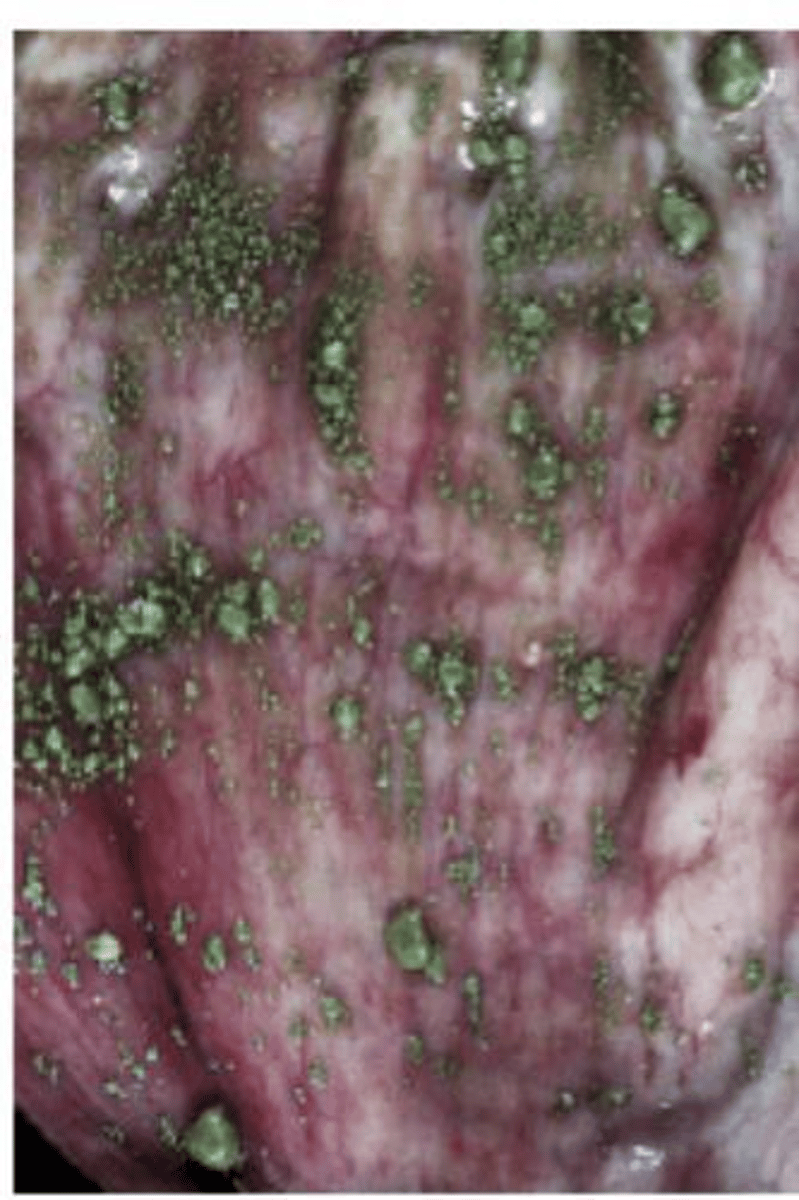 <p>A circulatory disorder characterized by the dilation of capillaries or terminal arteries.</p>