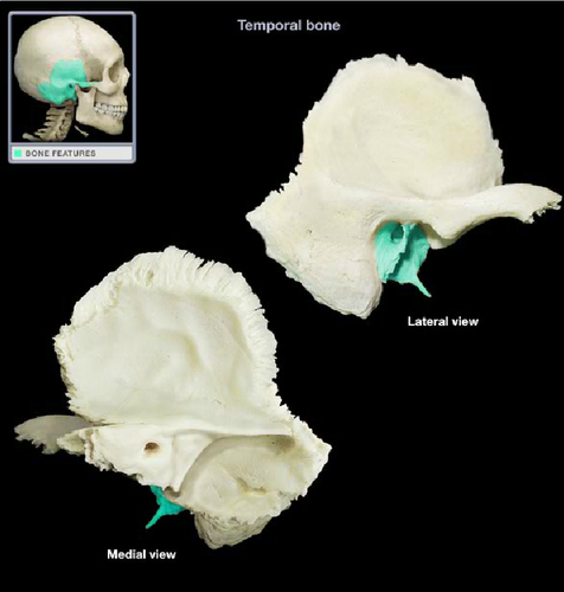 <p>lies posterior to the TMI, its anterior surface forms the rear wall of the mandibular fossa</p>