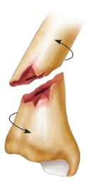 <p>fracture</p>