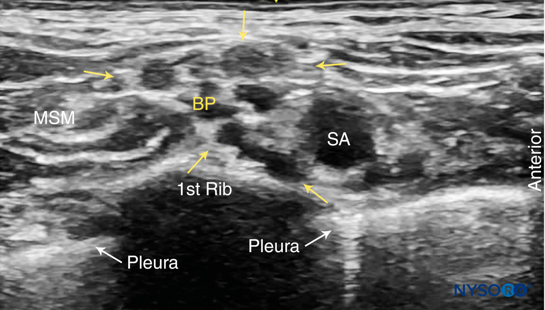 <p>the anterior and middle scalenes. </p><p>Recall that the subclavian artery courses over the first rib in between the anterior and middle scalenes. </p>