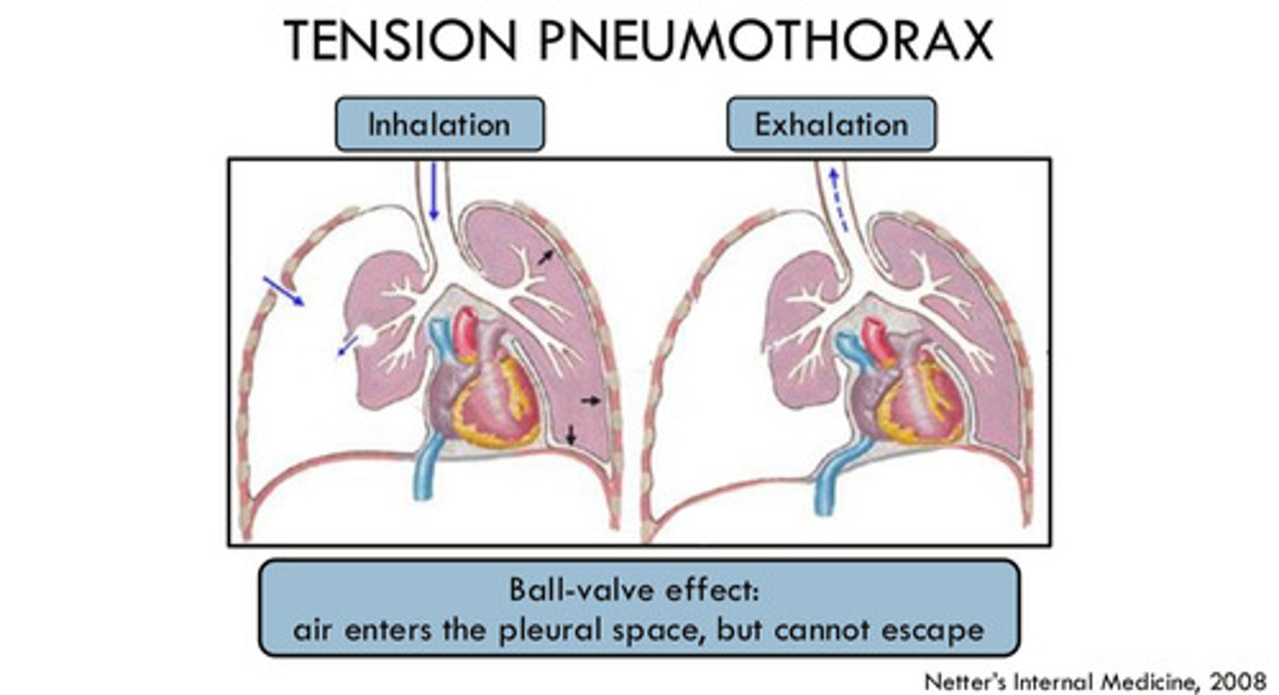 <p>pneumothorax with rapid accumulation of air in the pleural space (this air cannot escape) that can increase intrathoracic pressure —&gt; results in compression of the lung on the affected side and pressure on the heart and great vessels, pushing them away from the affected side; a <strong>medical emergency</strong>!!!</p>