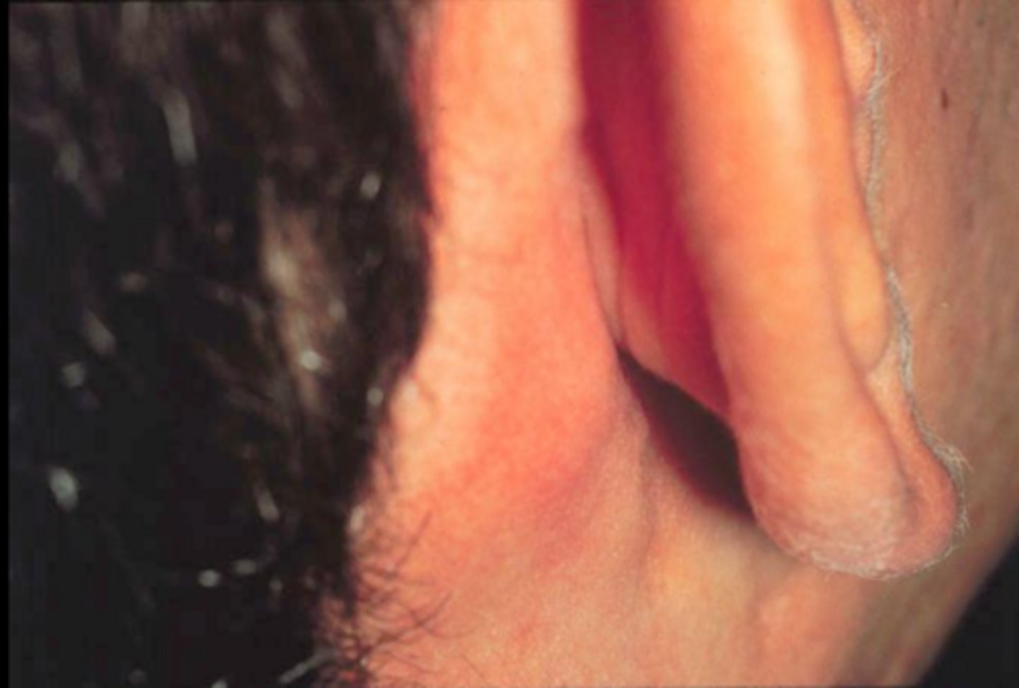 <p>infectious mononucleosis</p>