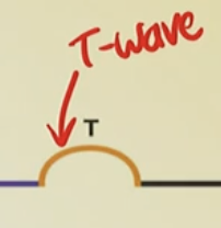 <p><strong>What event is represented by the T wave on the ECG?</strong> </p><p>A. Atrial depolarization<br>B. Ventricular depolarization<br>C. Atrial repolarization<br>D. Ventricular repolarization</p>