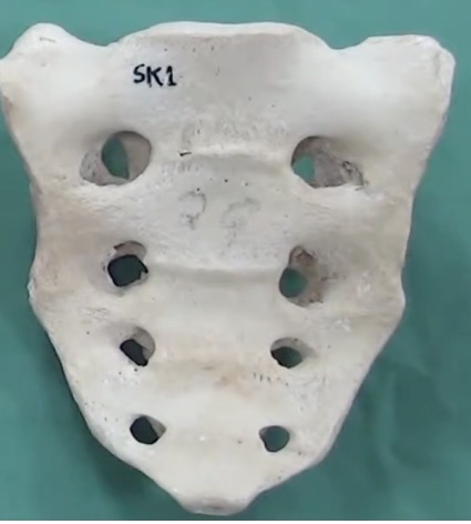 <p>What part of the vertebrae is this?</p>