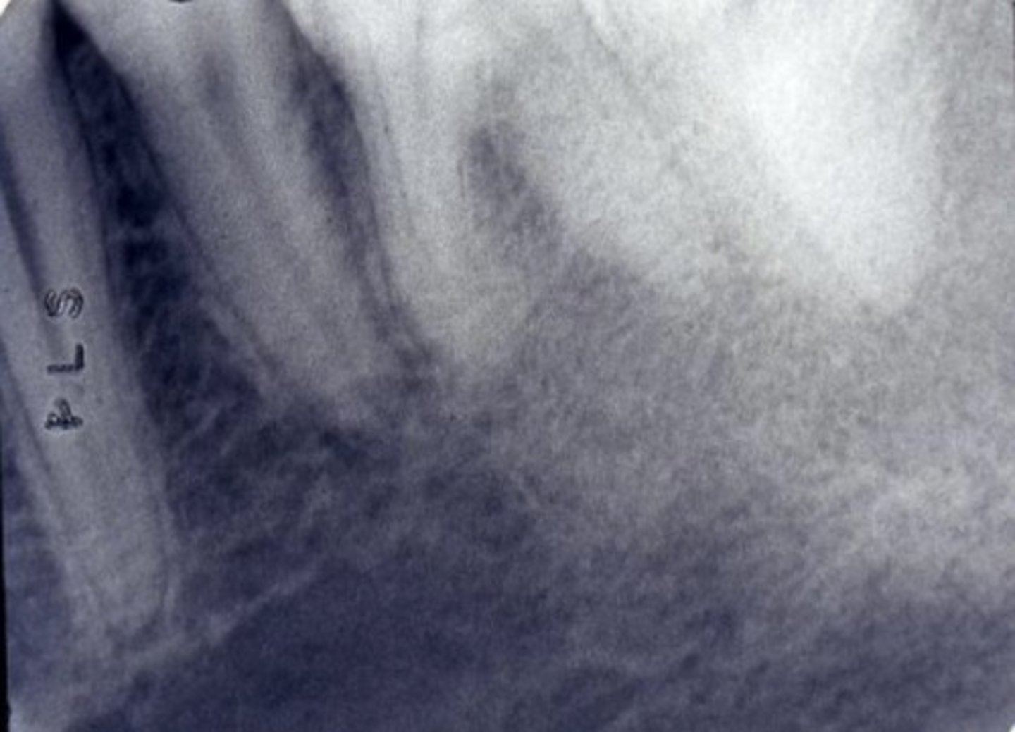 <p>What type of trabecular pattern is exhibited in this radiograph?</p>