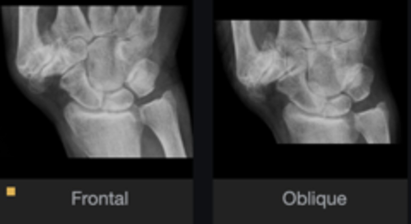 <p>Dislocation/diastasis</p>