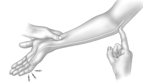 <p><span style="font-family: Calibri, sans-serif">Cubital tunnel syndrome (ulnar nerve irritation)&nbsp;</span></p><p><span style="font-family: Calibri, sans-serif">Positive sign is a tingling sensation in the pinky and ring finger</span></p>