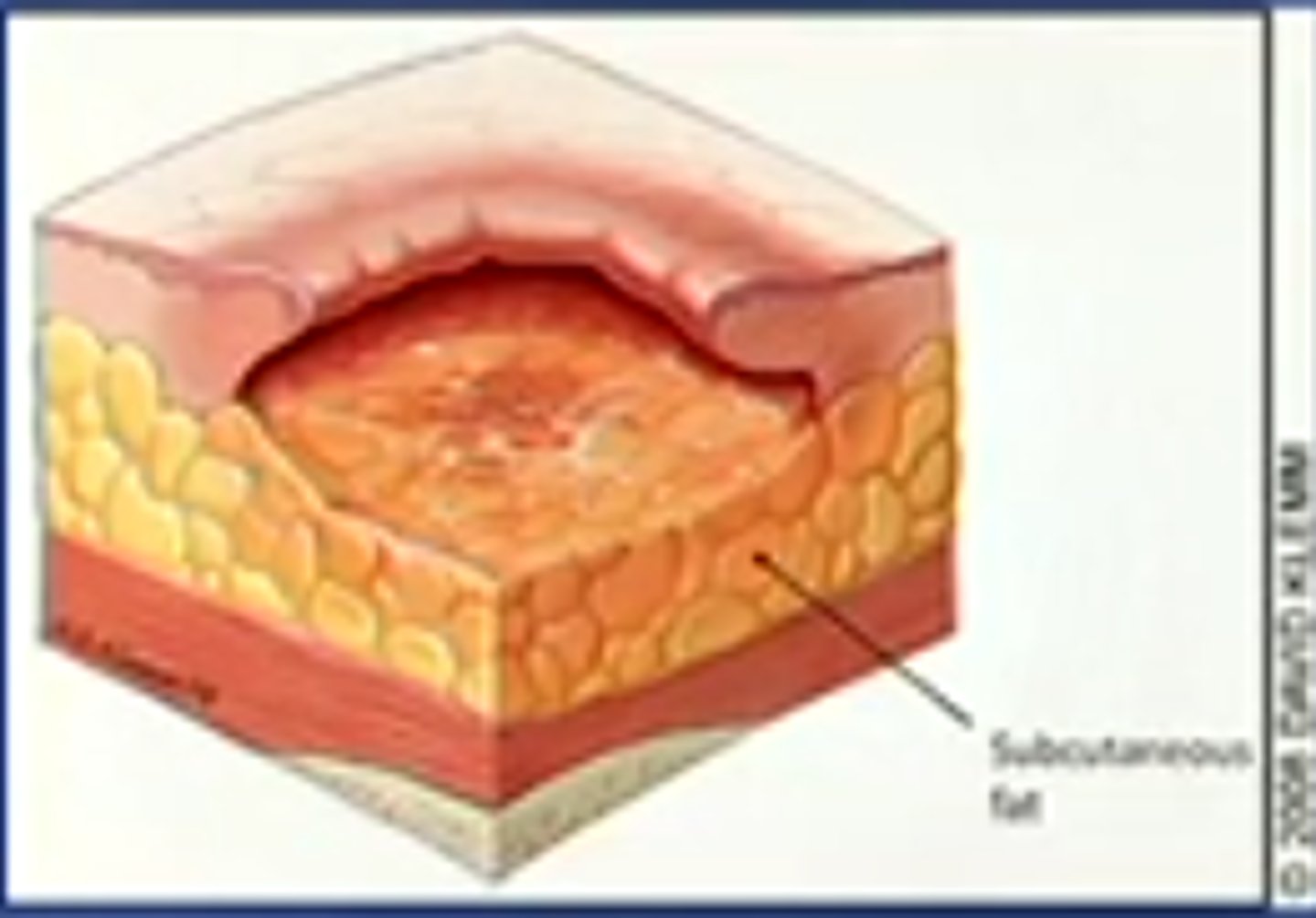 <p>full-thickness skin loss, involving damage or loss of subcutaneous tissue</p>
