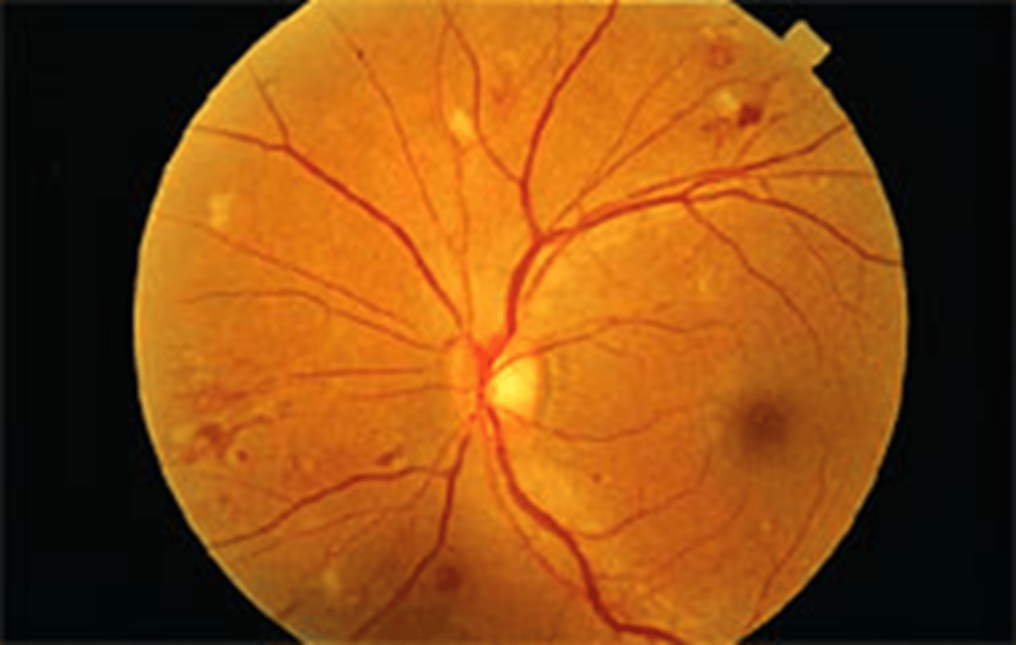 <p>fusiform: spindle shaped and associated with exudation. ruptured ones cause hemorrhage and exudation at any level of the retina</p><p>saccular RAM: small sac. more likely to reslut in hemorrhaging</p><p>superior temporal arcade</p>