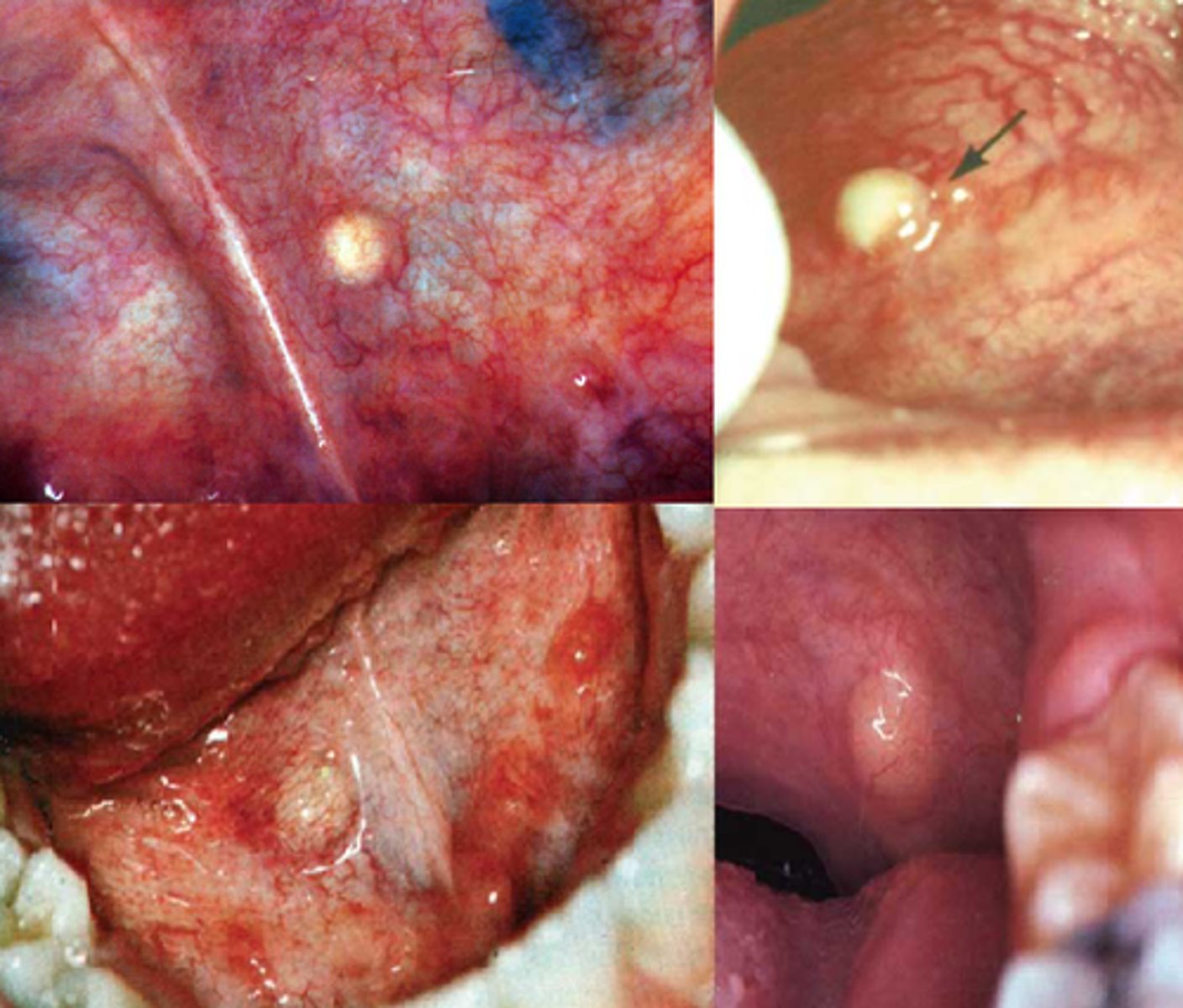 <p>Intraorally:</p><p>1. floor of mouth</p><p>2. ventral/posterior tongue</p>