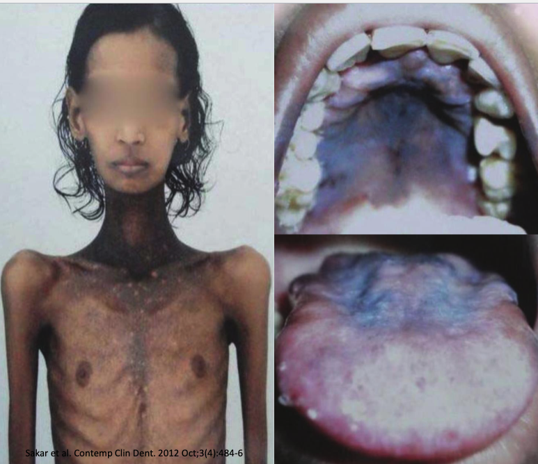 <ol><li><p>bronze pigmentation of skin&nbsp;</p></li><li><p>insufficient production of adrenal corticosteroids&nbsp;</p></li><li><p>weight loss&nbsp;</p></li><li><p>postural hypotension&nbsp;</p></li></ol><p></p>