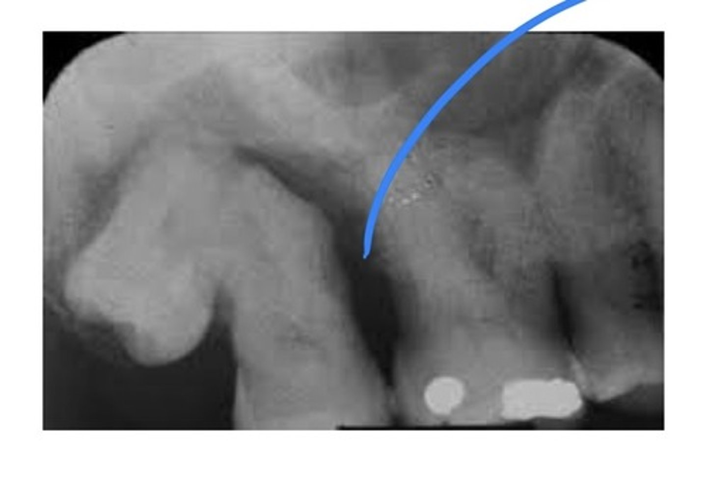 <p>Usually adjacent teeth are united by cementum. Usually discovered on a radiograph.</p>