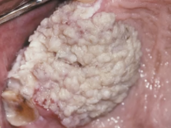 <p>What is the prevalence of Verrucous Carcinoma?</p>