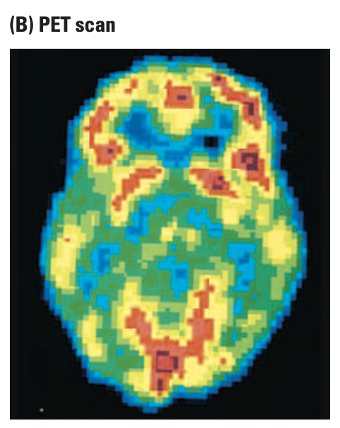 positron emission tomography (PET)